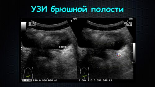 Узи брюшной полости